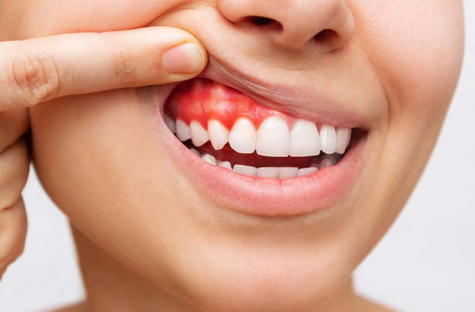آبسه دندان چیست ( راه های درمان آن )