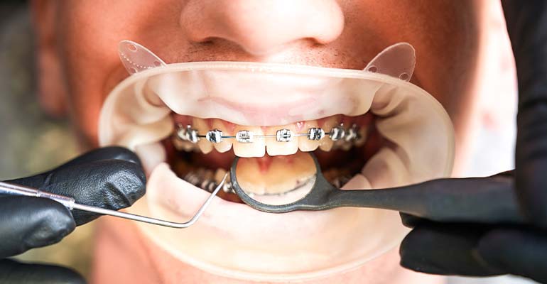 چرا باید دندان ها ارتودنسی شود ؟