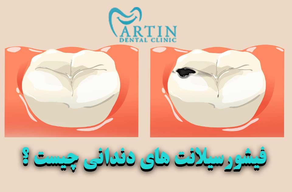 فیشور سیلانت های دندانی چیست ؟