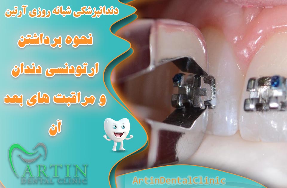 نحوه برداشتن ارتودنسی دندان و مراقبت‌های پس از آن