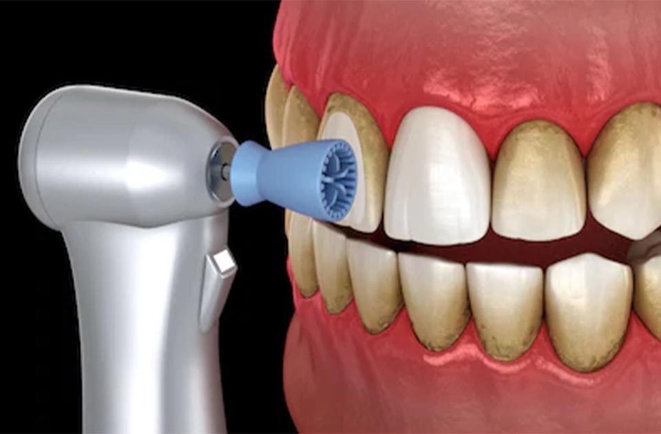 مراقبت های بعد از جرم گیری دندان چه می باشد ؟