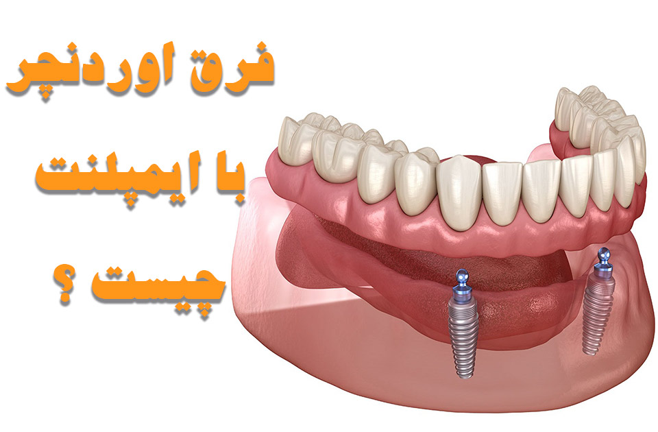 فرق اوردنچر با ایمپلنت دندان چیست ؟
