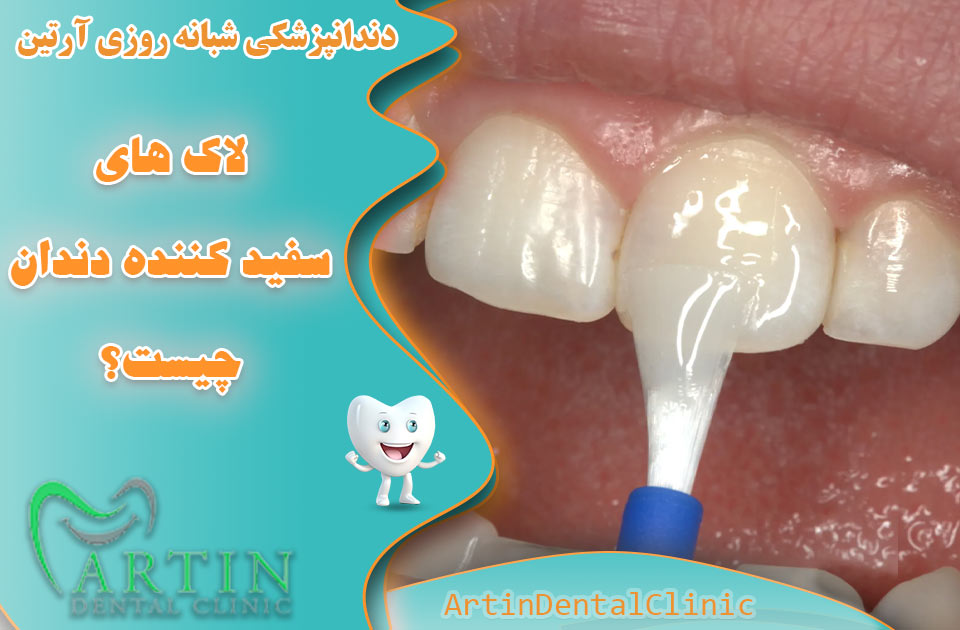 لاک های سفید کننده دندان چیست؟