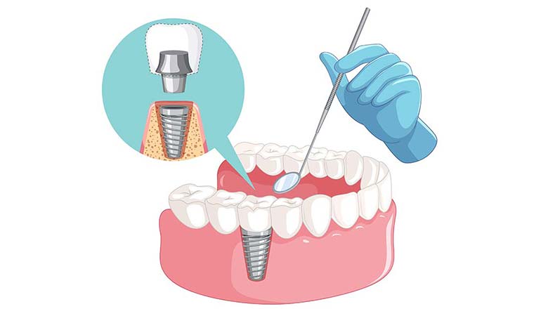 ایمپلنت دندان چگونه انجام میشود ؟