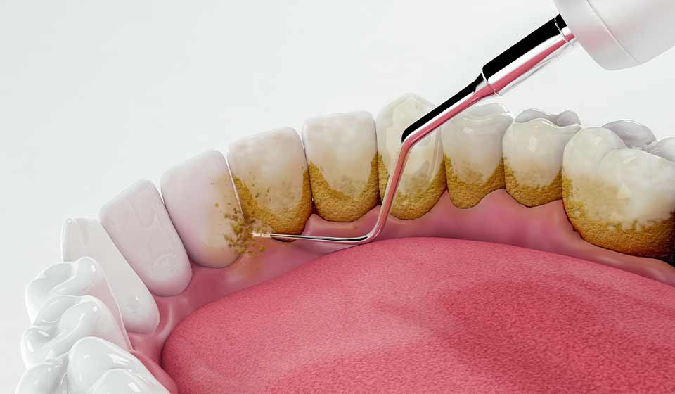 جرم گیری دندان چیست ؟ ( چگونه انجام می شود )