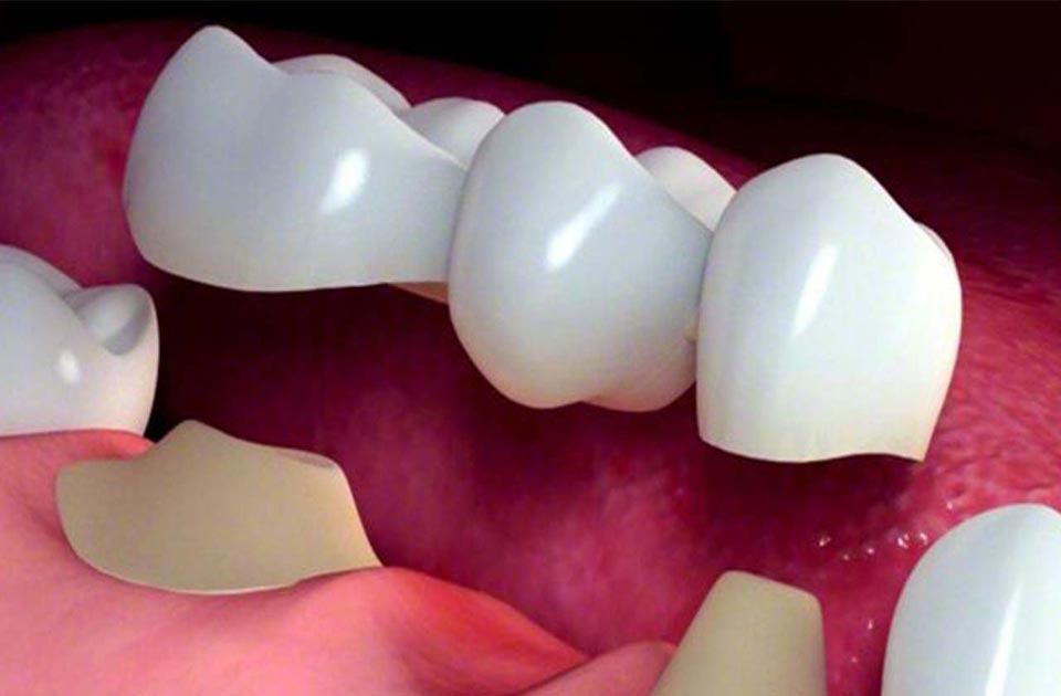 انواع روکش دندان کدام اند ؟
