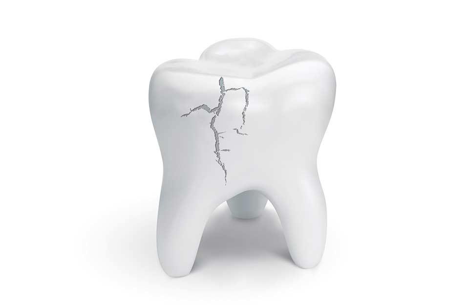 ترمیم شکستگی دندان چگونه انجام می شود ؟