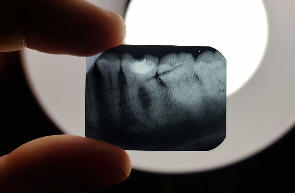 رادیوگرافی دندان چیست ؟ (انواع رادیوگرافی)
