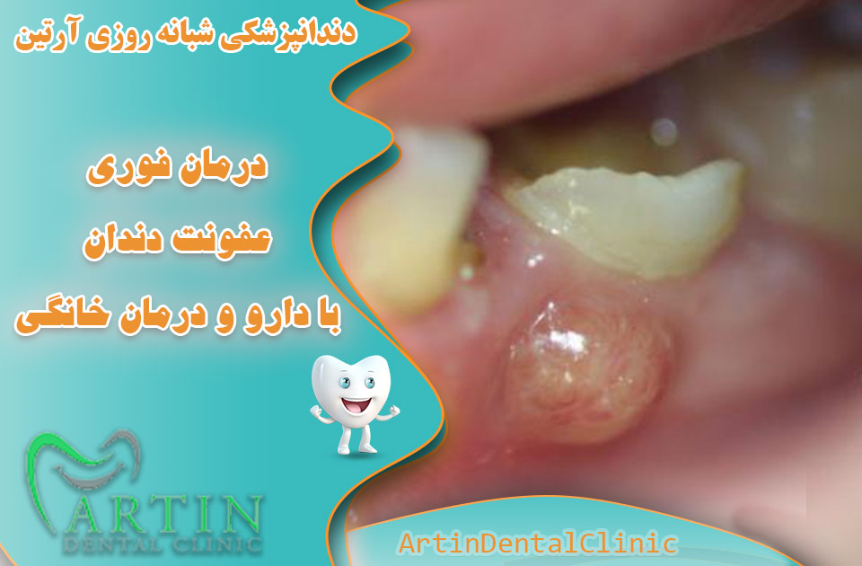 درمان فوری عفونت دندان با دارو و درمان خانگی