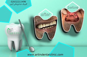 نمونه کار ایمپلنت دندان در دندانپزشکی آرتین در کرج