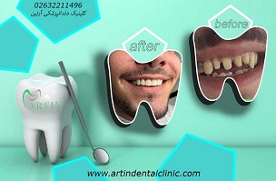 نمونه کار کامپوزیت دندان در کرج